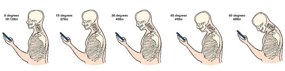 Example of tech neck progression